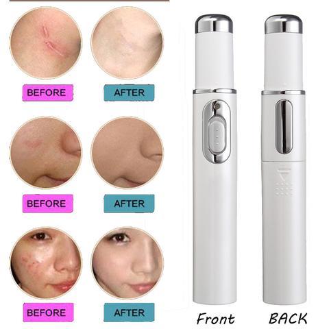 Laser Pen Soft Scar Wrinkle Removal